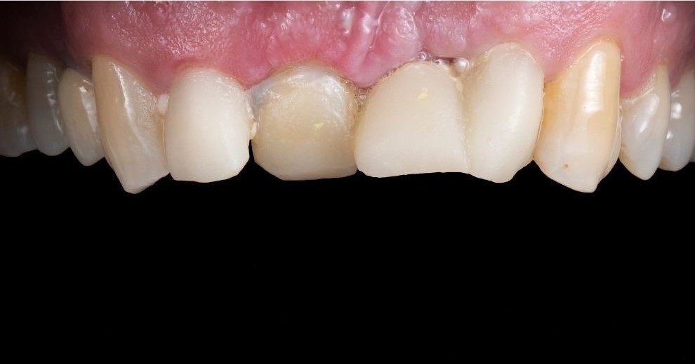 Dental Crown - Copy