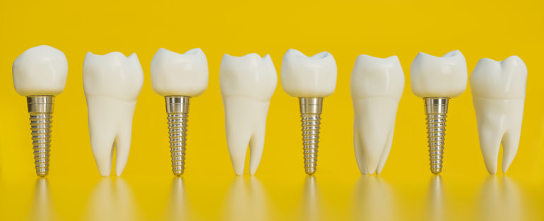 How Much do Dental Implants Cost?